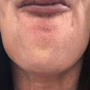 Botox® After | Cherry Medical Aesthetics | Denver