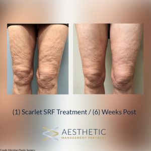 Scarlet SRF Treatment/ (6) Weeks Post | Cherry Medical Aesthetics | Denver
