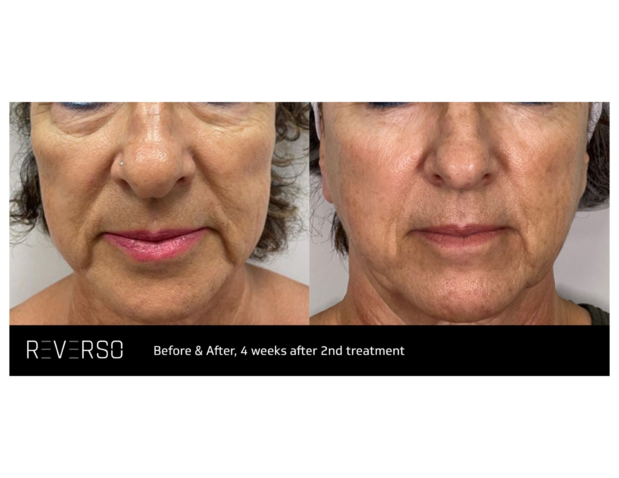 Reverso Denver, CO Cherry Medical Aesthetics