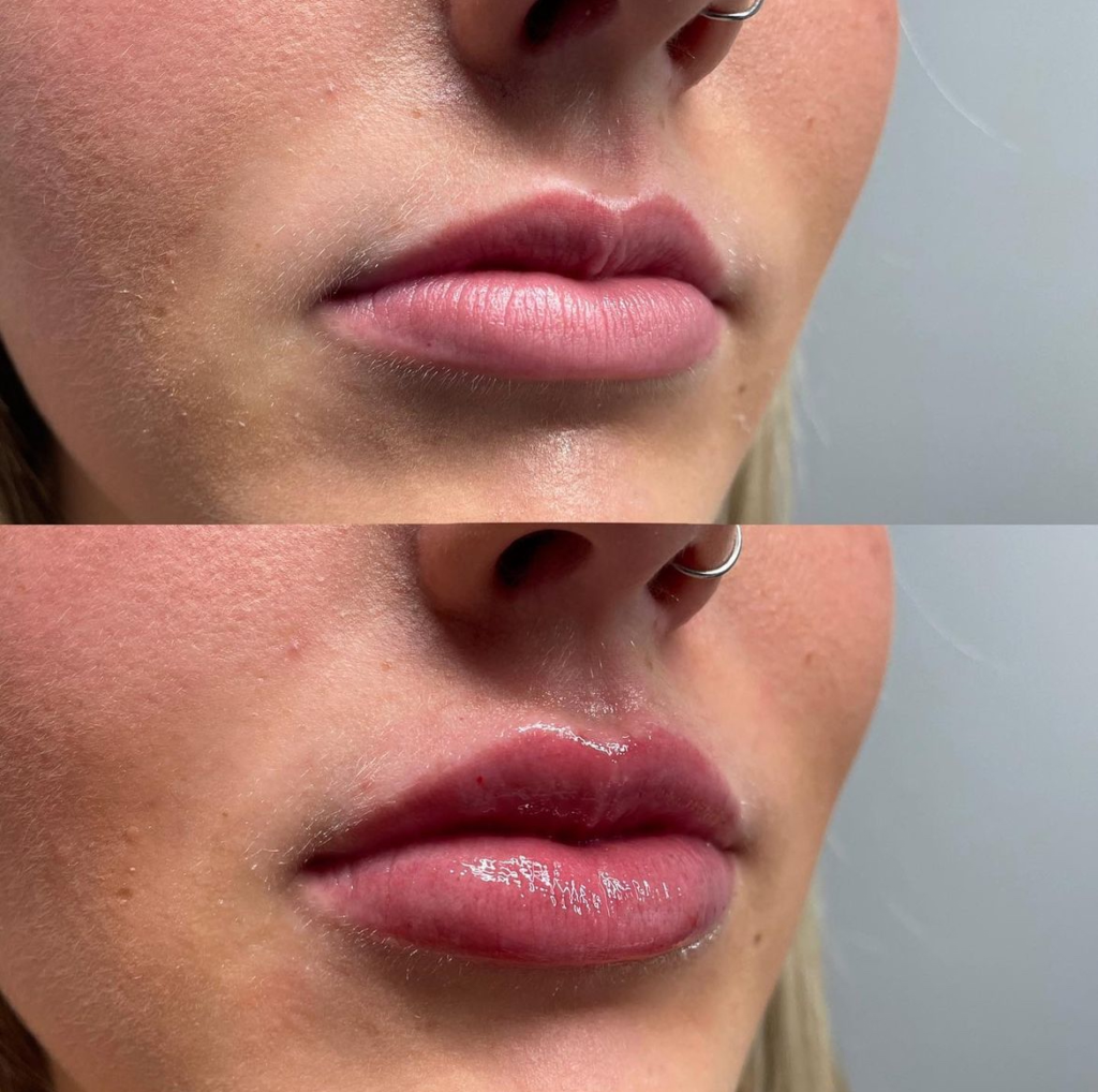 Juvederm_before&after (2)