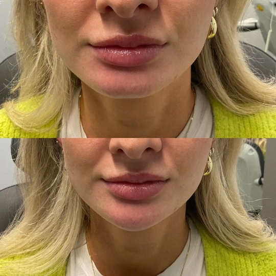 Juvederm_before&after