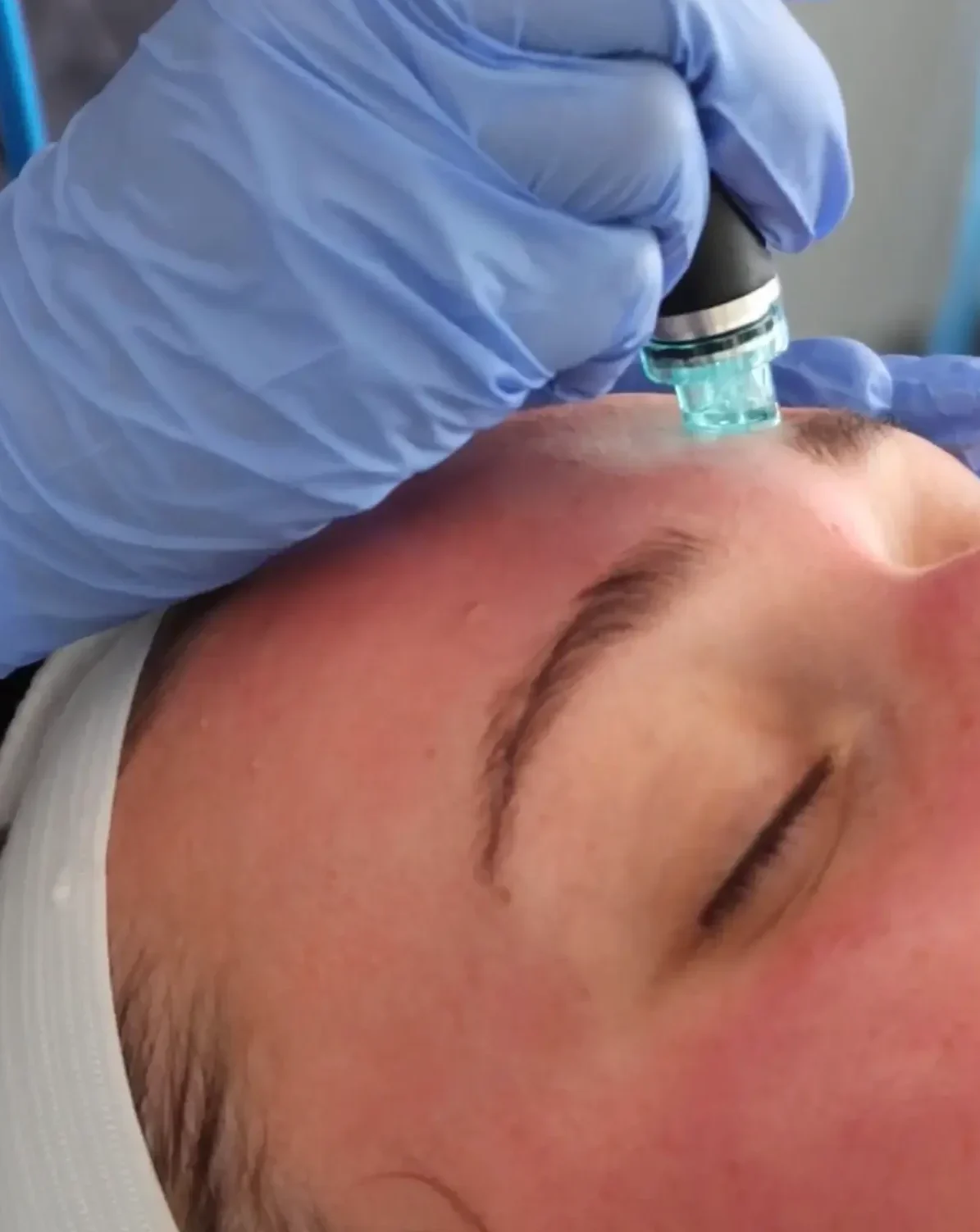 Facials Treatment in Denver, CO | Cherry Medical Aesthetics in Denver, CO
