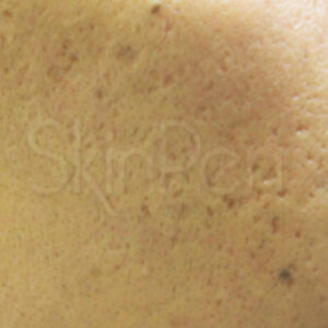 SkinPen® After | Cherry Medical Aesthetics | Denver
