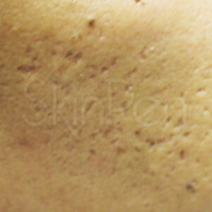 SkinPen®Before | Cherry Medical Aesthetics | Denver