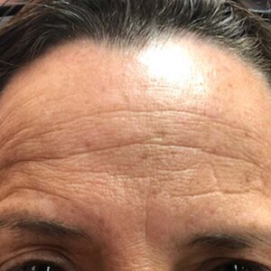 Botox® Before | Cherry Medical Aesthetics | Denver