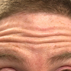 Botox® Before | Cherry Medical Aesthetics | Denver