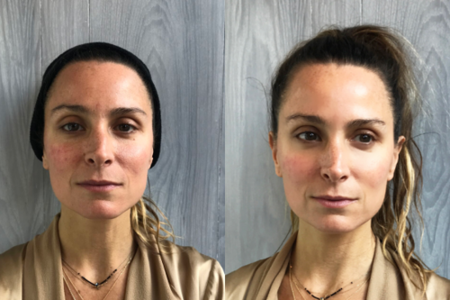 Facial | Cherry Medical Aesthetics | Denver