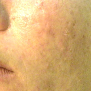 Salt Facial After | Cherry Medical Aesthetics | Denver